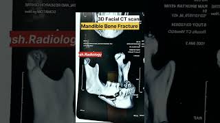 Mandible Bone Fracture 3D Face CT Scan Radiology Case shorts ctscan [upl. by Adnilemreh]