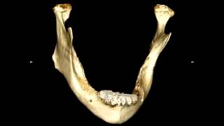 ricostruzione 3d mandibola  Dott Paolo Rossetti Milano [upl. by Whetstone]