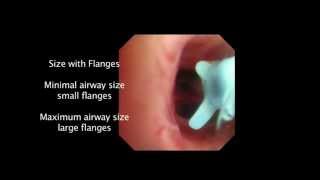 Endobronchial Valves for emphysema final [upl. by Kutzenco]