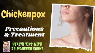 Chickenpox Precautions amp Treatment [upl. by Oesile638]