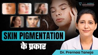 Skin Pigmentation के प्रकार  Clinic Eximus [upl. by Leile396]