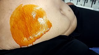 The color and shape of 18 liters of abdominal fluid ascites in the patient with liver cancer [upl. by Mages]