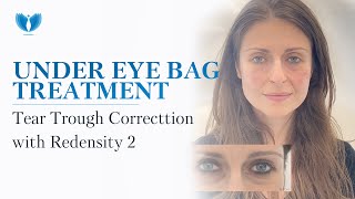 Tear Trough Treatment  Under Eye Area Correction with Dermal Filler Redensity 2  Under Eye Bags [upl. by Horatius]