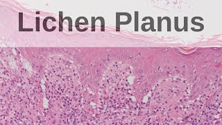 Lichen Planus  Pathology mini tutorial [upl. by Yvonne322]