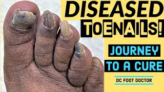 Diseased Toenails Journey To A Cure Trimming Fungal Toenails Onychomycosis [upl. by Sheryl]