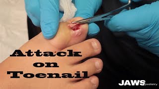 INFECTED INGROWN TOENAIL WITH DR WAGNER [upl. by Ellehcam321]