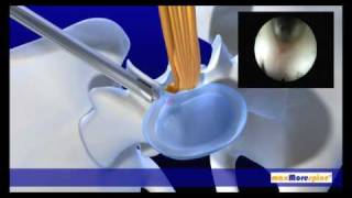 maxMorespine endoscopic animation [upl. by Elnukeda763]