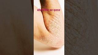 सोरायसिस का इलाज 🔥🩸 Psoriasis Symptoms Medicine🩸🔥 [upl. by Jillayne405]