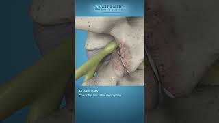 What is Endoscopic Lumbar Foraminotomy Shorts Atlantic Spine Center [upl. by Dareg]