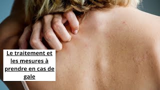 Le traitement et les mesures à prendre en cas de gale [upl. by Cesare89]