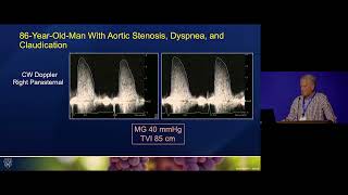 Severe Aortic Stenosis [upl. by Selima]