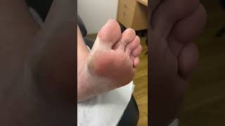 Ditch the discomfort Watch an Aussie podiatrists big toe callus removal wizardry [upl. by Igiul]