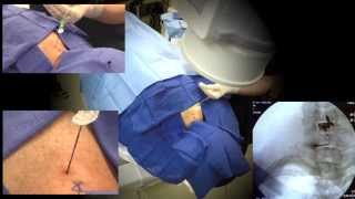 WATCH a Cervical Epidural Steroid Injection Demonstration  LIVE [upl. by Anissej]