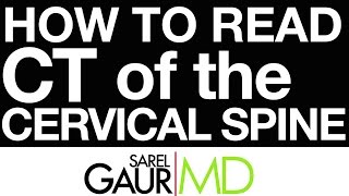 How to Read CT of the Cervical Spine [upl. by Enelhtac]