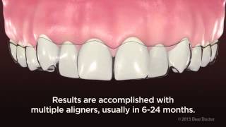 ClearPath Aligners  NEW VIDEO for PATIENT EDUCATION by AACD [upl. by Anelaf185]