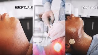 1 YEAR CHIN LIPO UPDATE  MY EXPERIENCE RECOVERY COST ETC [upl. by Mareld991]