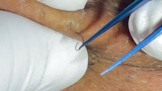 Beard Plucking Ingrown Hair Removal Zoom in Satisfying ep26 [upl. by Eveiveneg815]