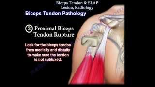 Biceps Tendon amp SLAP Lesion Radiology  Everything You Need To Know  Dr Nabil Ebraheim [upl. by Kiele18]