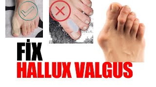 Fix Hallux Valgus  Hallux Valgus Taping  Pt Aynur BAŞ [upl. by Ailev]