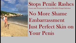 Stops Penile Rashes  Causes and Treatment for Sexual Health amp Fungal Infection [upl. by Anedal]