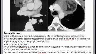 Anterior mediastinal mass [upl. by Pacifica358]