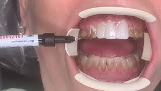 Houston Cosmetic DentistReally dark teeth Veneers can make the discoloration disappear [upl. by Nytsud]