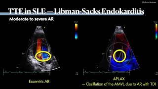 〖Echocardiography〗 Libman Sacks endocarditis🫀 [upl. by Eilegna581]