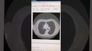 Real time Lung Nodule detection using chest CT slices with AI [upl. by Macdonell793]