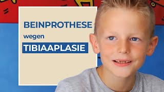 Moritz Weg mit Tibiaaplasie Dysmelie Orthoprothese KnieexProthese Badeprothese [upl. by Luzader]