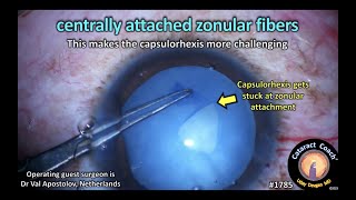 CataractCoach™1785 centrally attached zonular fibers [upl. by Keane]