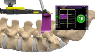 MAS® PLIF Patient Animation [upl. by Lancelle]