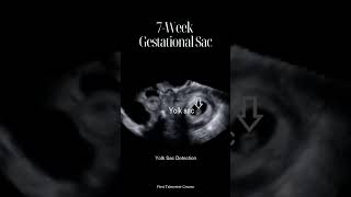 7Week Gestational Sac [upl. by Lau376]