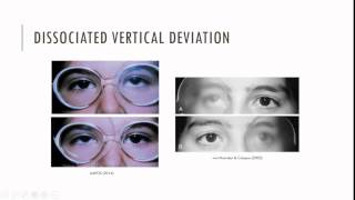 Essential Infantile Esotropia Characteristics [upl. by Mayer]