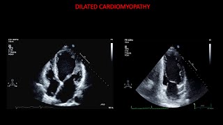 Echocardiography in dilated cardiomyopathy [upl. by Rabassa857]