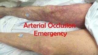 Acute Complete Occlusion of the Leg Arteries [upl. by Shaeffer]