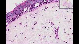 Histopathology Nose Nasal polyp [upl. by Bethena]