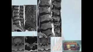 Upright MRI of the lumbosacral spine 10 years after [upl. by Annirtak]