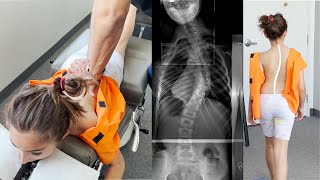 Scoliosis Treatment with Gonstead Chiropractic Care Ep2 Dr Rahim [upl. by Broder]