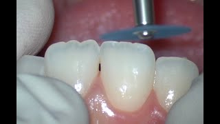 Enameloplasty Upper Central Incisors [upl. by Linskey608]