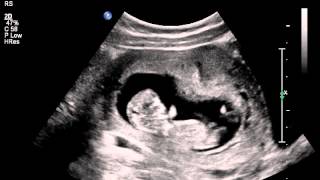 Jumping womb dancer baby ultrasound scan [upl. by Accemahs293]