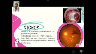 Oftalmología  Opacidad Vítrea por Hemorragia Vítrea [upl. by Ahsika841]