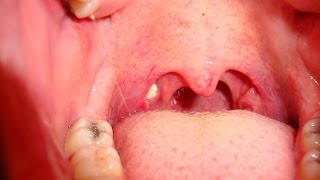 Tonsil Stones  How to Remove Tonsil Stones [upl. by Senzer]