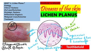 Oral Lichen planus Part 1 Causes Pathogenesis Clinical features Skin lesions [upl. by Chesney122]