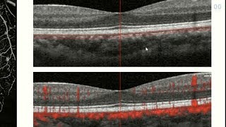 OCT Angiography Revolutionizing Vitreoretinal Disease [upl. by Akialam879]