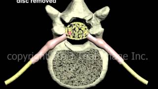 Lumbar Discectomy disc removal and Fusion  Narration and Animation by Cal Shipley MD [upl. by Airakaz]