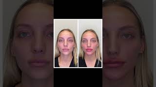 Facial Balancing at New U Womens Clinic amp Aesthetics  Kennewick WA [upl. by Nnylanna]