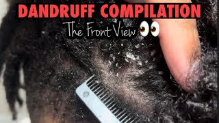 Different views of the front dandruff  Compilation  Weekly Vlog youtube youtuber support [upl. by Yddub]