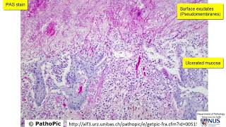 Oesophagus  Candidiasis Moniliasis [upl. by Janot]