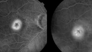 FFA CLASSIFICATION OF CNVM Choroidal neovascular membrane  Occult vs Classic CNVM [upl. by Htilil]