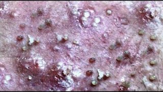 How To Get Rid of a Pimple In One Day  Homemade Pimple amp Acne Treatment  Asad Ansari [upl. by Cecilia]